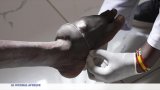 Kenya : le mycétome, une maladie endémique pourtant encore négligée